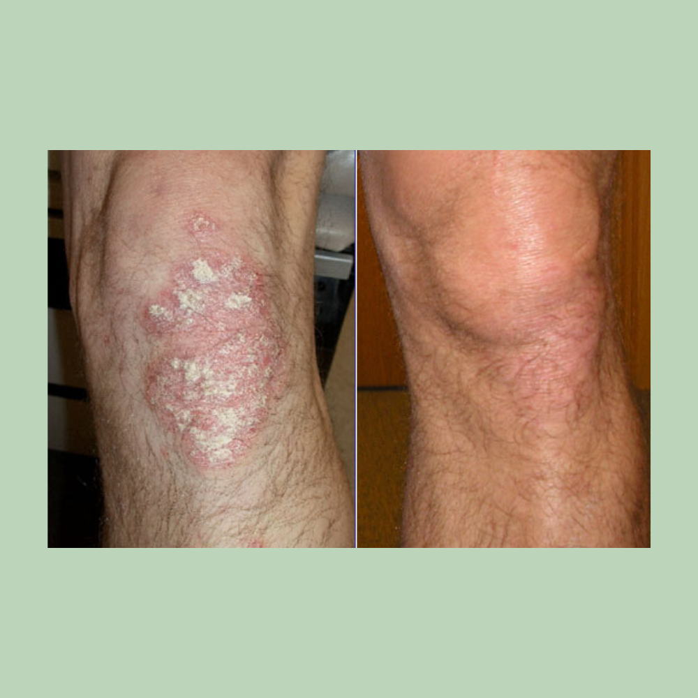 Clobetasol Propionate Lotion .05% (Cormax)