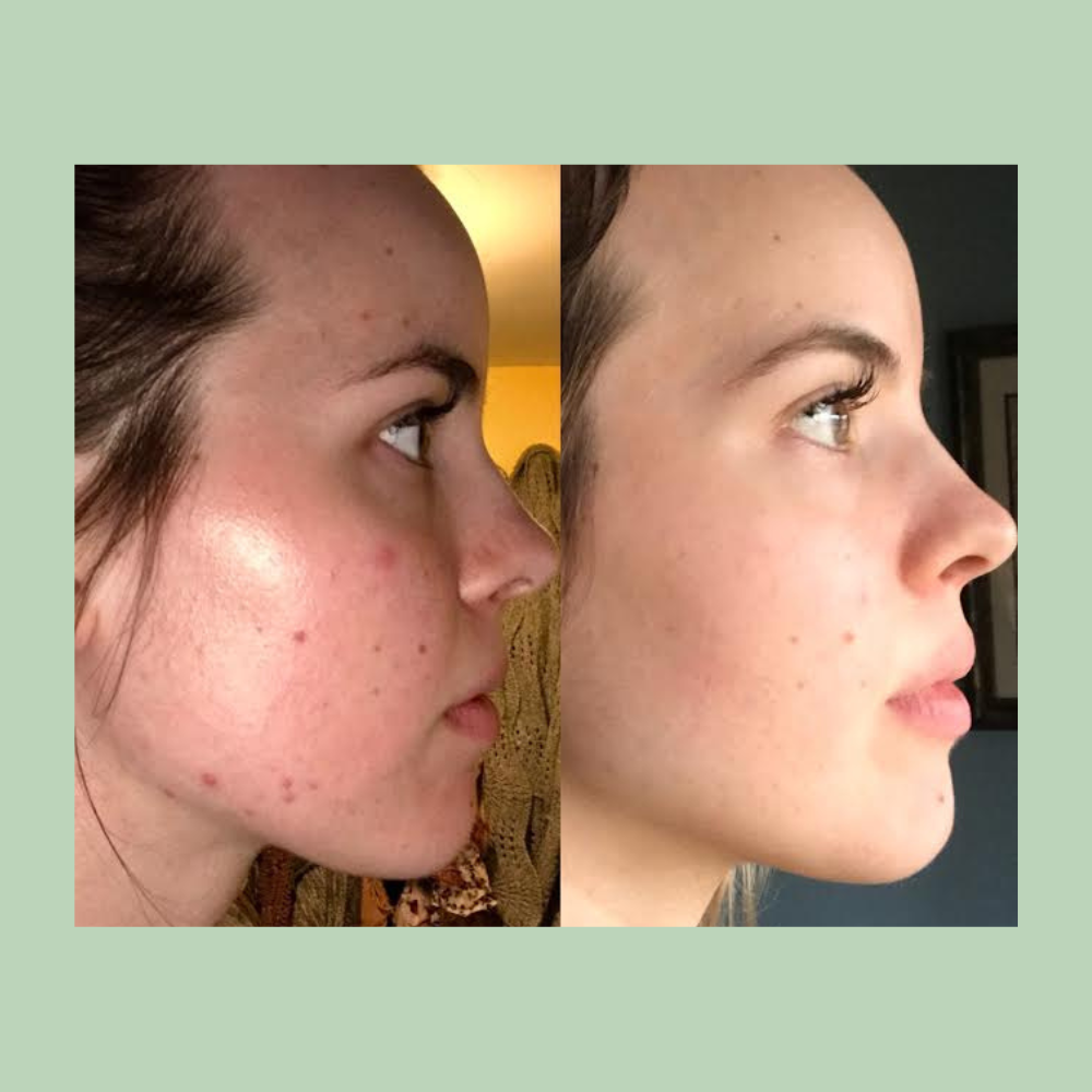 Dapsone Gel 5% (Aczone)