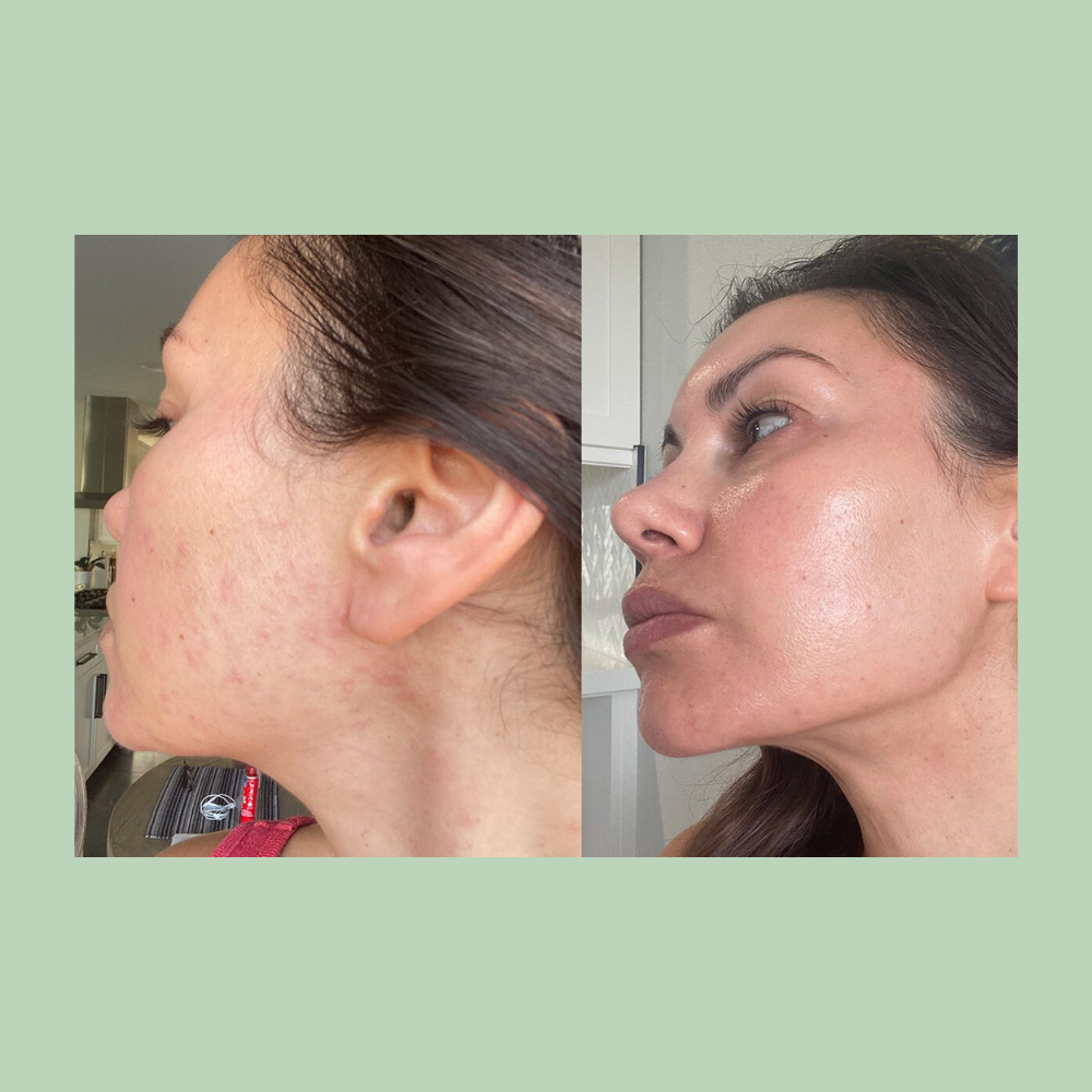 Ketoconazole Cream 2%