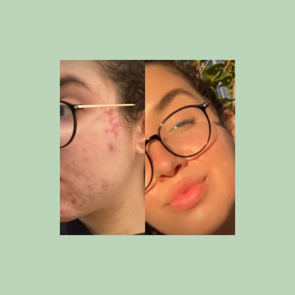 Clindamycin Phosphate Gel, USP 1%